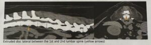 CT spine disc extrusion L1-L2
